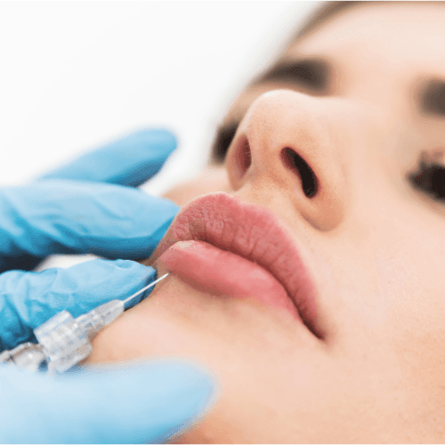 Dermal Filler Treatments