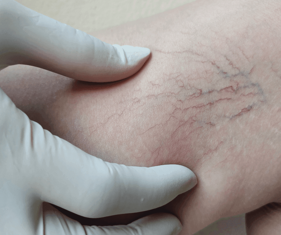 Microsclerotherapy Treatment